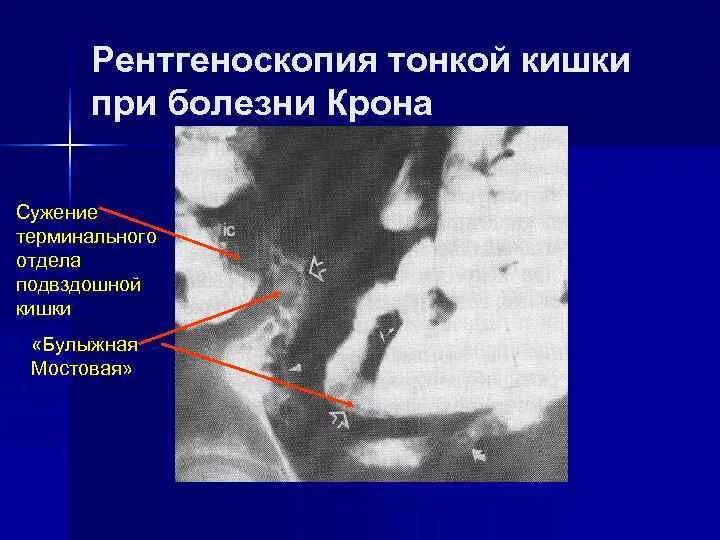 Симптом булыжной мостовой болезнь крона рентгеноскопия. Рентгенологическое исследование при болезни крона. Стриктура терминального отдела подвздошной кишки. Терминальный отдел подвздошной кишки. Язва кт