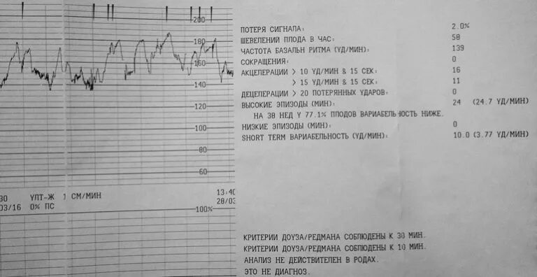 КТГ на 33 неделе беременности. Шевеления плода на КТГ. Норма шевелений плода на 34 неделе беременности. На КТГ 34 неделе беременности шевеление плода норма. Нормы шевелений по неделям