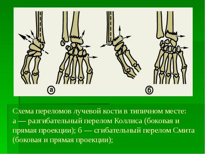 Повреждения монтеджи и галеацци. Дистального метаэпифиза лучевая кость. Перелом дистальная метаэпифища лучевой кости. Перелом лучевой кости рентген. Дистальный перелом лучевой кости.