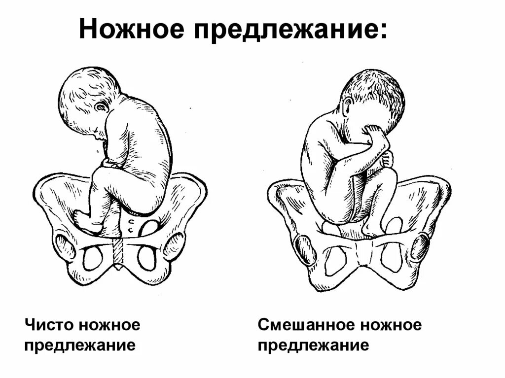 Тазовое предлежание показание. Ножное предлежание плода. Тазовое ножное предлежание. Смешанное ножное предлежание.