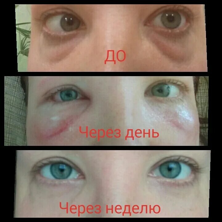 Лазерная блефаропластика. Отзывы прооперированных нижних, верхних век, фото до и