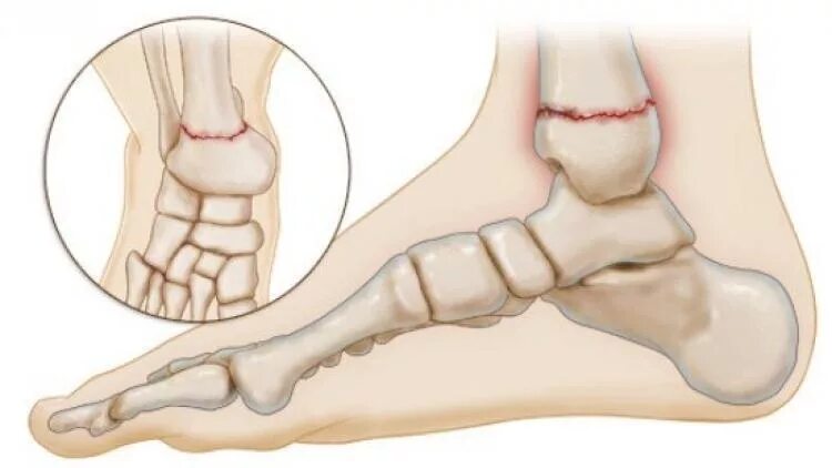 Перелом голеностопного сустава. Лодыжечная кость перелом. Перелом лодыжки кости стопы. Перелом кости голеностопа. Травма голеностопа перелом.