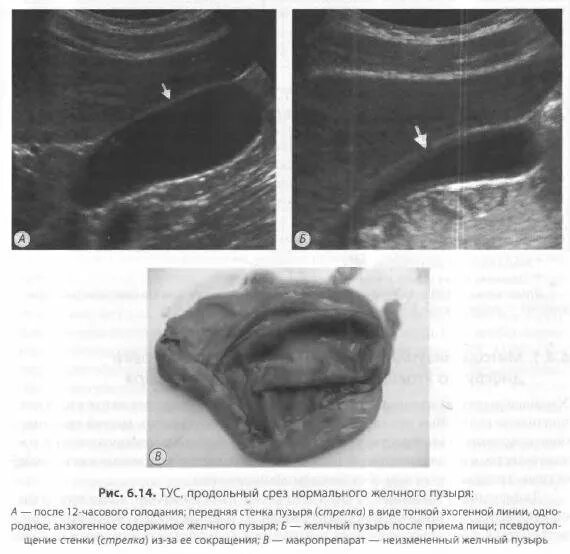 Изменение стенок желчного пузыря. Стенка желчного пузыря фиброзирована. Слоистость стенок желчного пузыря по УЗИ. Стенка передняя в желчном пузыре по УЗИ. Толщина стенки желчного пузыря по результатам УЗИ.