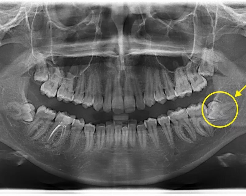 Снимок зубов видное. Ортопантомограмма зубы мудрости. Ортопантомограмма челюсти. Ортопантомограмма кариес.