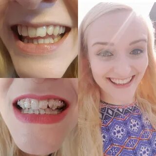 BeforeAfter frenectomy and 2 months with braces. 