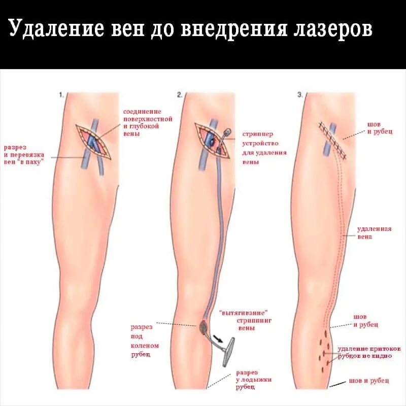 Операция кроссэктомия флебэктомия. Флебэктомия БПВ правой нижней конечности. Тромбоз бпв