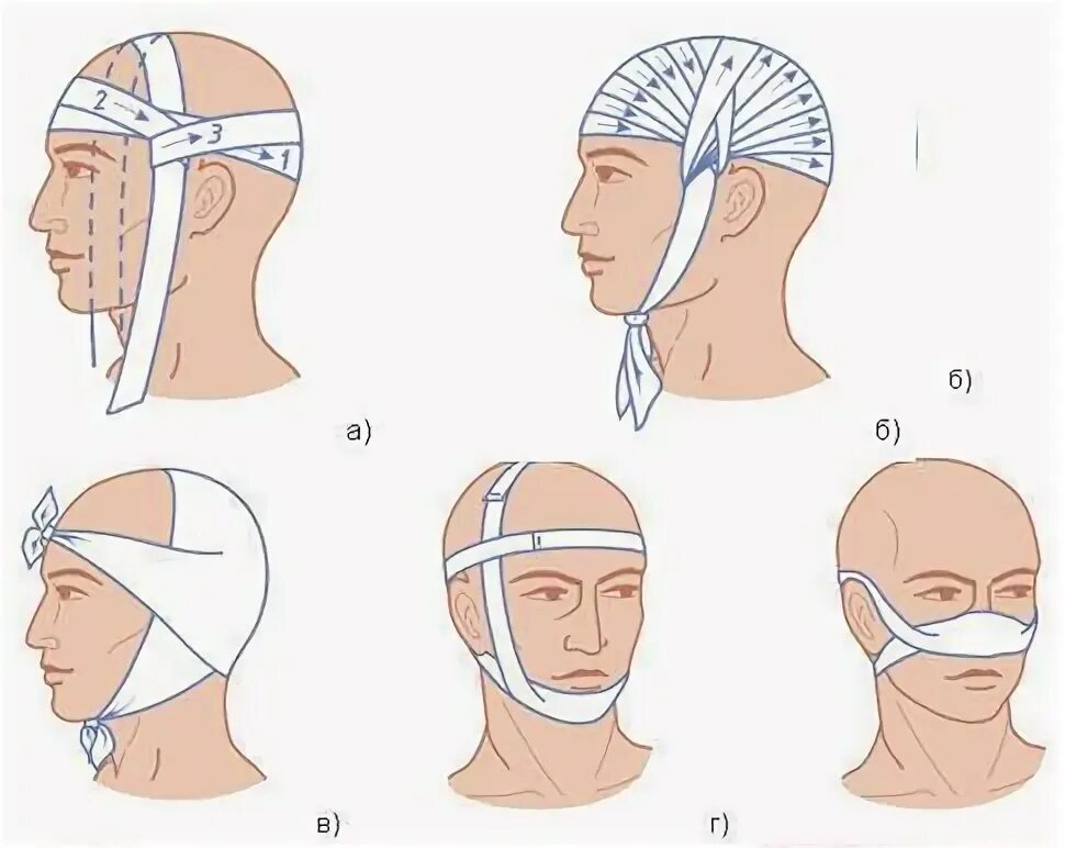 Как перевязывать голову. Перевязка головы бинтом чепец. Повязка на чепец бинтом. Наложение повязки чепец. Повязка чепец техника.