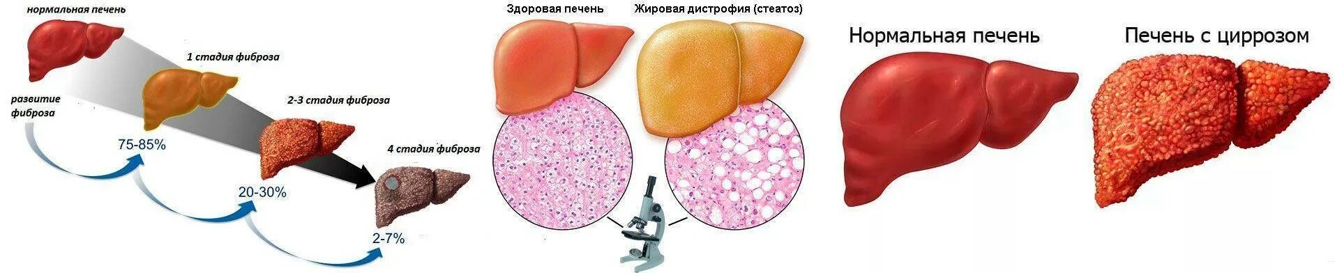 Почему печень желтая. Стадии поражения цирроза печени. Гипертрофический цирроз печени у КРС.