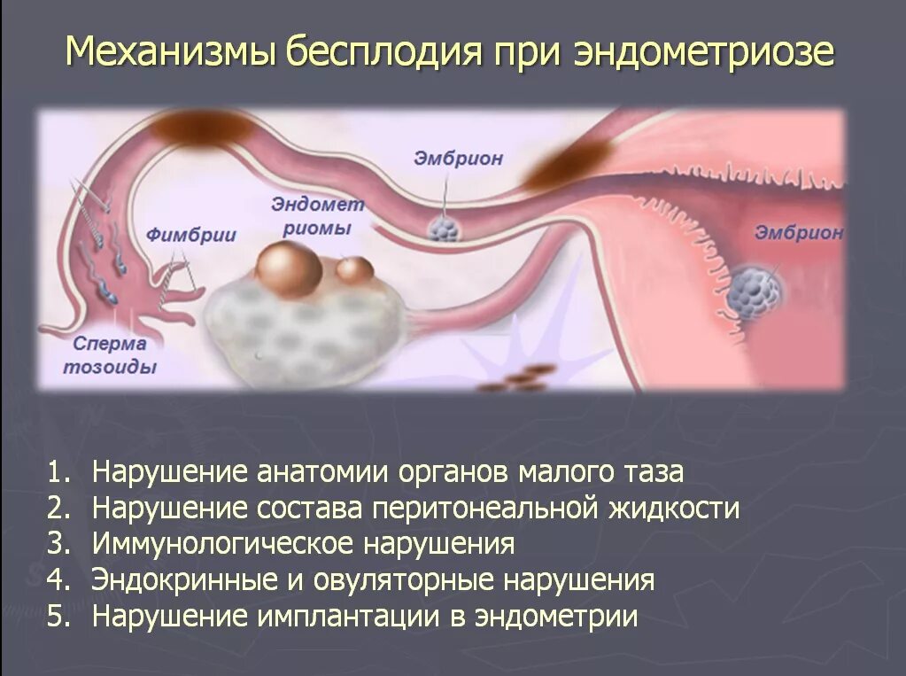 Терапия эндометриоза. Эндометриоз и бесплодие.