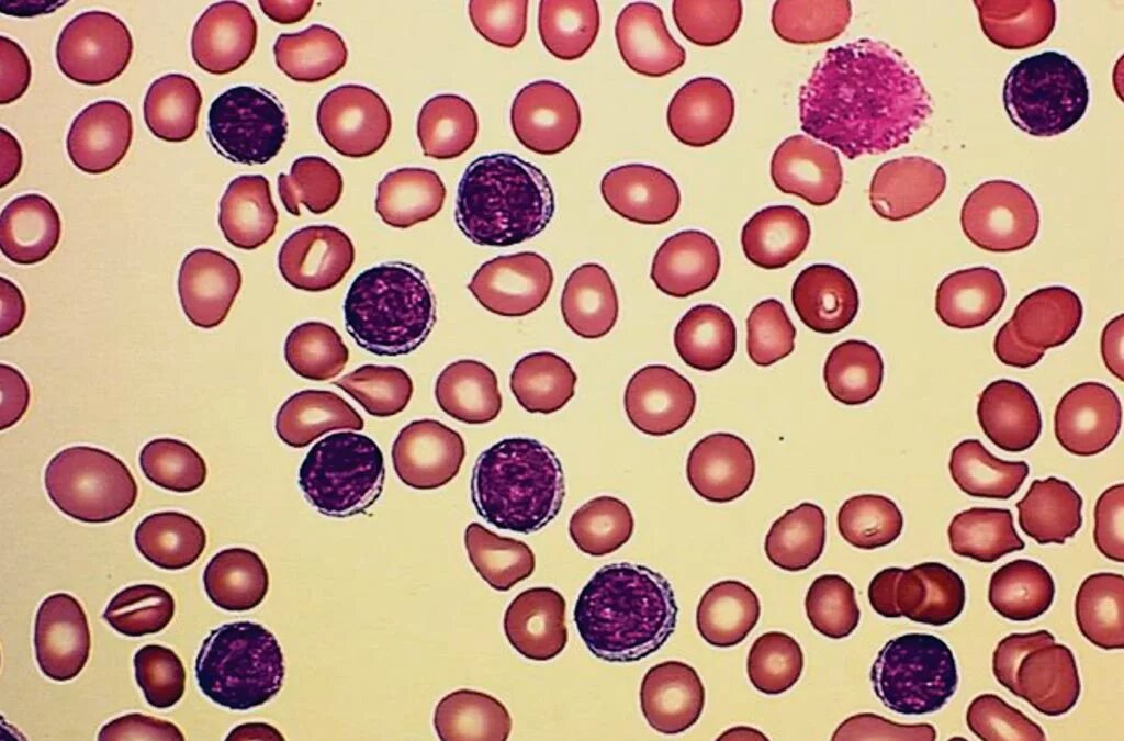В -лимфоциты хронический лимфолейкоз. Т клеточный лимфолейкоз. Хронический лимфолейкоз под микроскопом. Хронический лимфоцитарный лейкоз (ХЛЛ). Т клетки крови