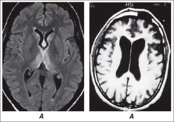 Энцефалопатия мозга последствия. Энцефалопатия Гайе-Вернике. Алкогольная энцефалопатия кт. Алкогольная энцефалопатия головного мозга на мрт. Острая некротизирующая энцефалопатия мрт.
