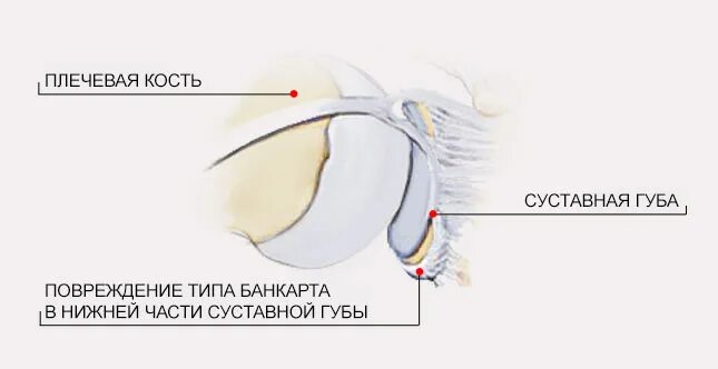 Суставная фиброзно-хрящевая губа гленоида. Губа гленоида плечевого сустава. Хрящевая губа плечевого сустава. Повреждение фиброзно-хрящевой губы.