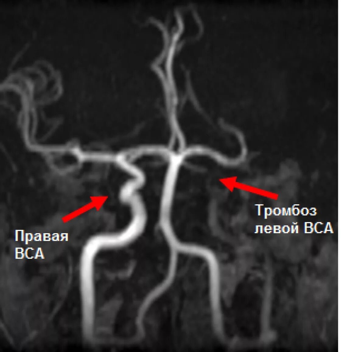 Тромбозы сосудов головного. Тромбоз внутренней сонной артерии мрт. Тромбоз внутренней сонной артерии кт. Тромбоз позвоночной артерии на мрт головного мозга. Сегменты ВСА на ангиографии.