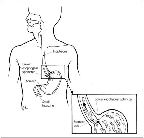 Сфинктеры пищеварительной системы. Клапан желудка и пищевода сфинктер. Пищеводно желудочный сфинктер. Нижний пищеводный сфинктер.
