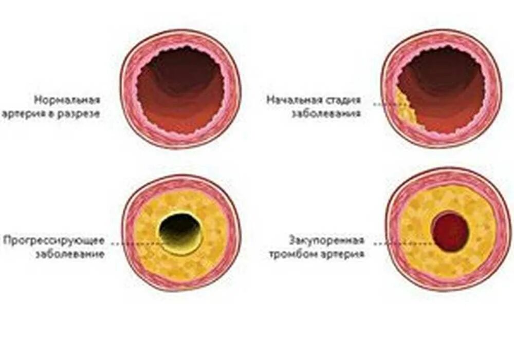 Атеросклеротические бляшки в сосудах. Атеросклеротическая бляшка в разрезе. Тромб норма