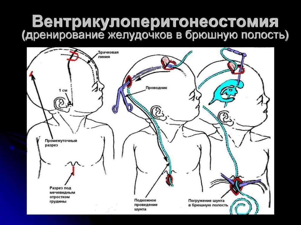 Головные шунты. Шунт при гидроцефалии схема дети. Вентрикулоперитонеальный шунт схема. Гидроцефалия операция шунт. Вентрикулоперитонеальное шунтирование при гидроцефалии техника.