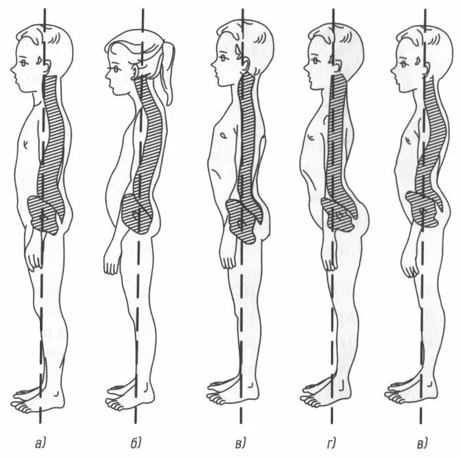 Типы осанки по штаффелю. Типы осанки человека по штаффелю. Лордотическая осанка у человека. Кифотическая осанка (гиперкифоз) это. Изгибы костей