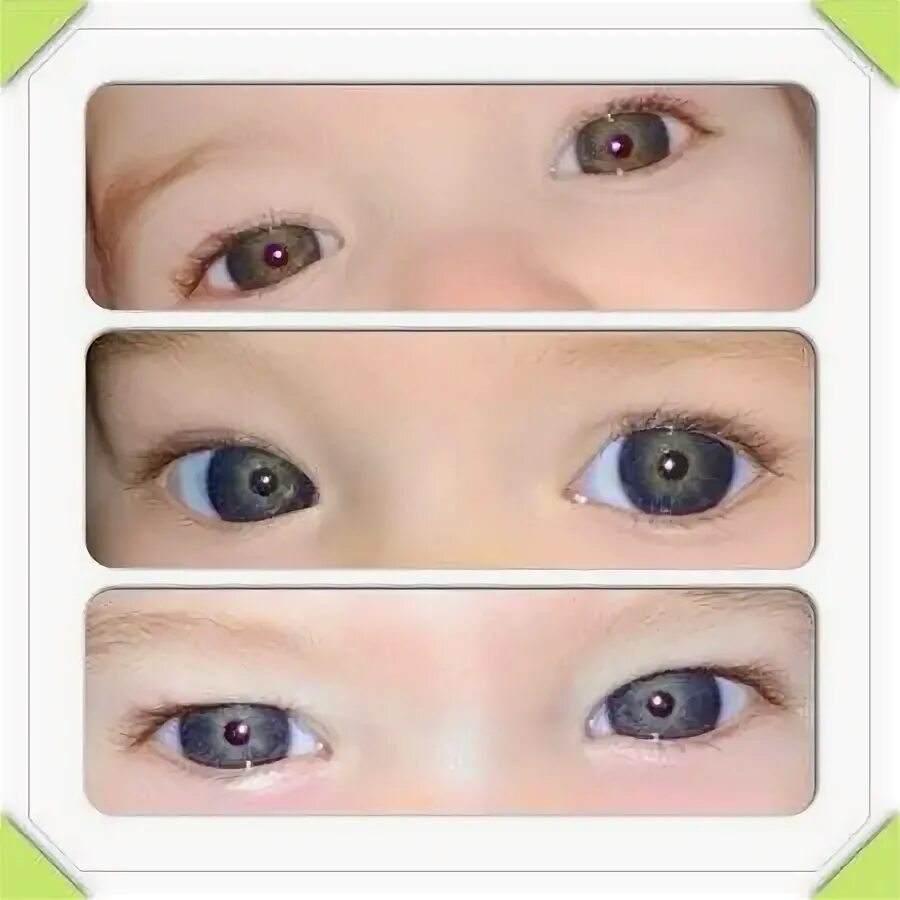 Процент рождения глаз