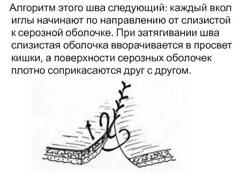 Как убрать швы после операции. Шов операции через год.