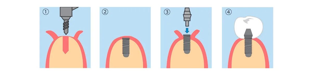Этапы имплантации зубов абатмент. Этапы имплантации зуба абатмент. Имплант в разрезе.