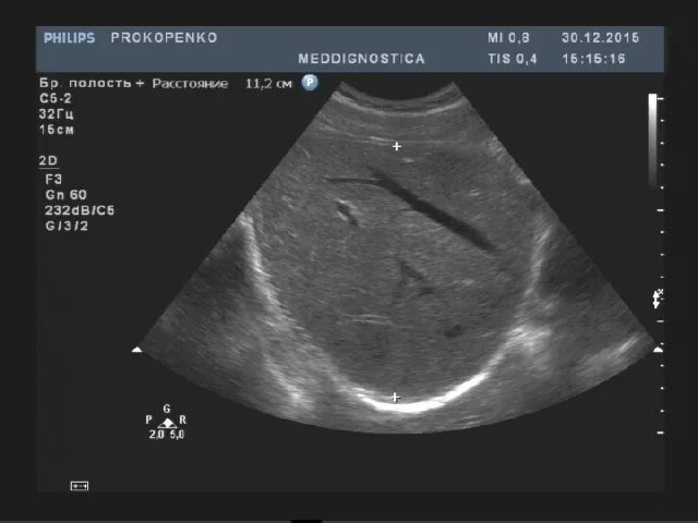 Измерение печени на УЗИ. Здоровая печень на УЗИ. КВР печени УЗИ. Измерение размеров печени на УЗИ.