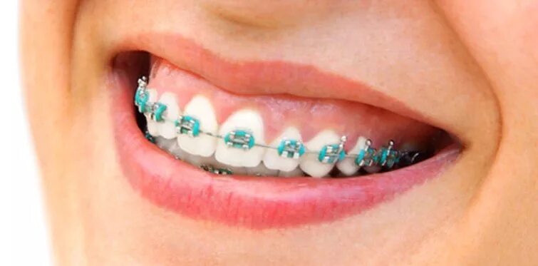Резинки для смещения зубов. Как ставят брекеты на зубы детям 12. Как ставят брекеты на зубы детям 12 лет. Брекеты на зубы для детей сколько стоят