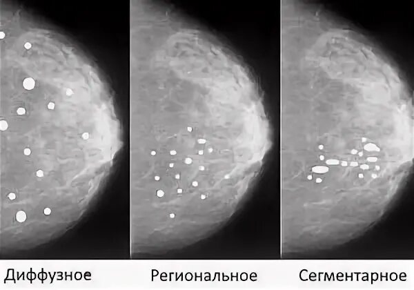 Округлые кальцинаты. Маммография микрокальцинаты. Кальцинаты на маммографии. Микрокальцинаты молочной железы. Маммография раковые микрокальцинаты.