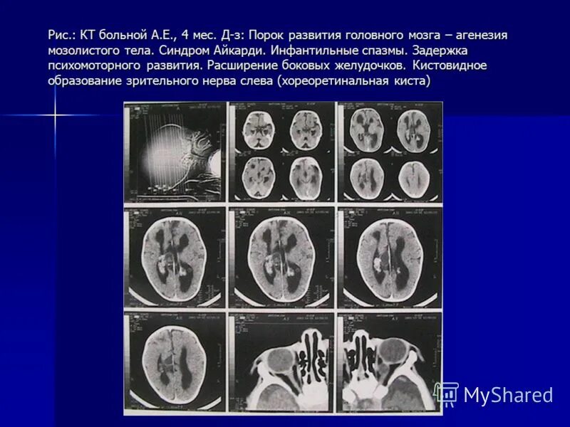 Аномалии развития головного мозга. Желудочки головного мозга на кт. Аномалии развития головного мозга мрт. Аномалии развития головного мозга. Аномалии развития мозга.