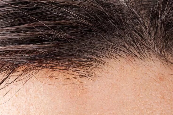 Has a cure for baldness been discovered?