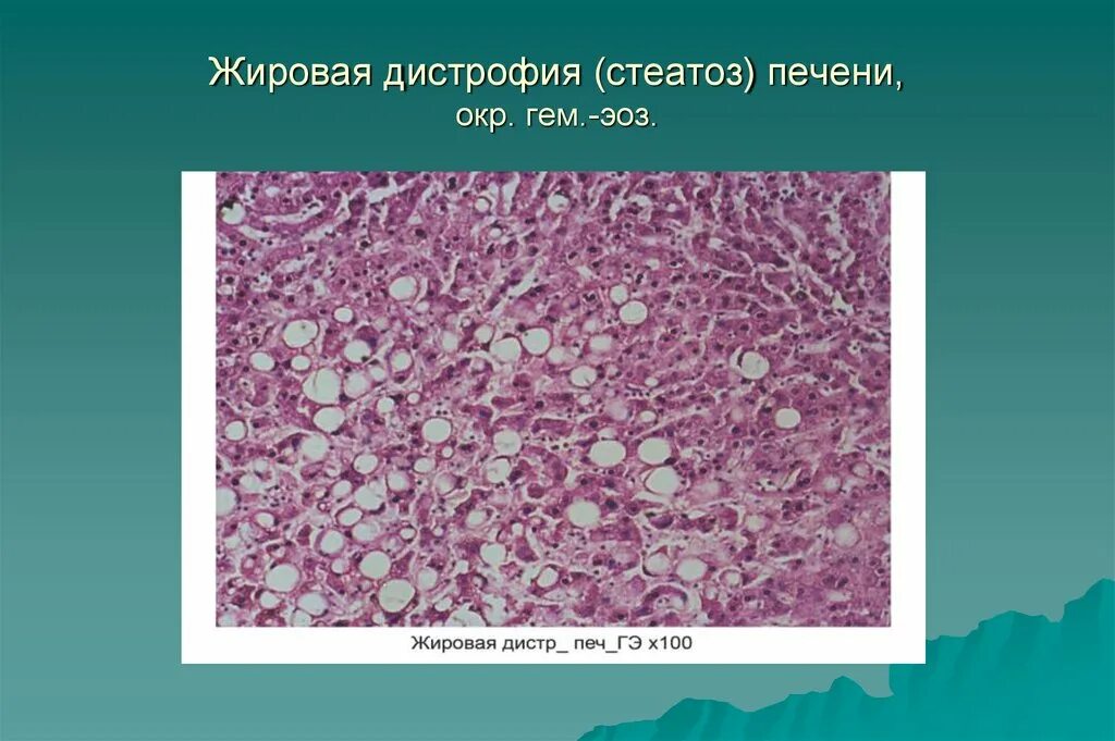 Признаки дистрофии печени. Массивный прогрессирующий некроз печени макро. Центролобулярные некрозы печени. Центролобулярные некрозы печени гистология. Цирроз печени макропрепарат печени.