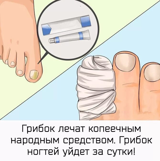 Лечение грибка врач. Чем лечить грибок ногтей. Грибок ногтя на 2 пальце ноги. Грибок ногтя третья стадия.