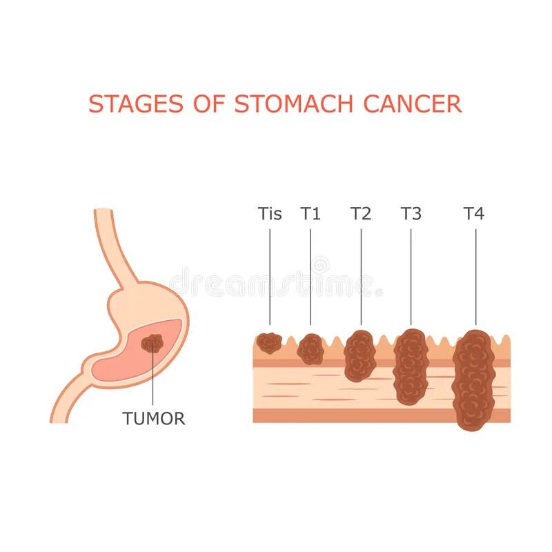 Раковая опухоль желудка. Раз желудка по стадиям. Вторая стадия онкологии желудка. Онкология желудка 4 стадия