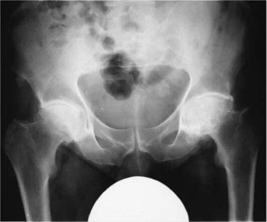 субхондральный склероз l2. опухоли тазобедренного сустава на рентгене. остеосклероз рентген снимок. склероз бедренных костей. остеопороз и остеосклероз.