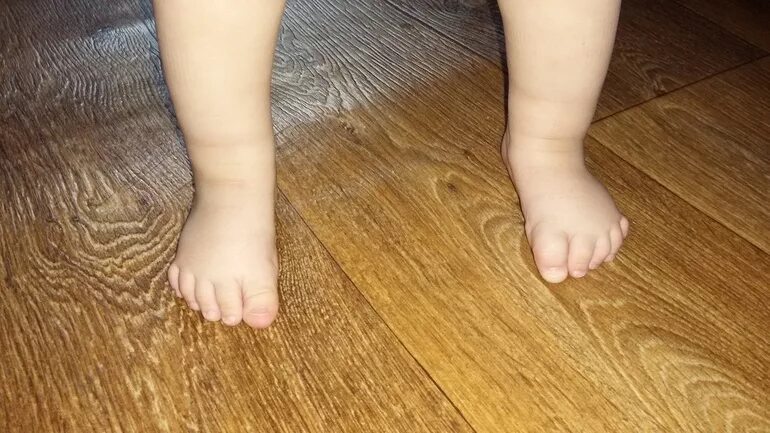 ребенок подворачивает ножку