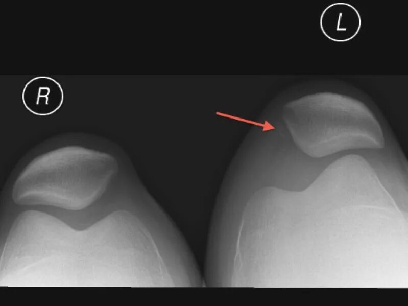 Латерализация надколенника. Смещение надколенника рентген. Вывих надколенника рентген. Латеральный подвывих надколенника рентген. Травматический вывих надколенника.
