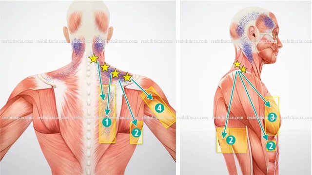 Лимфоузел в мышце. Миофасциальные триггерные точки спины. Миофасциальные триггерные точки шеи спины. Миофасциальный синдром триггерные точки спины. Трапециевидная мышца спины триггерные точки.