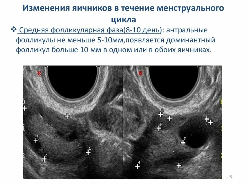 Функции фолликулов яичника. УЗИ мониторинг созревания фолликула. Фолликулы в яичниках 10 мм это норма. Фолликулы 6 мм