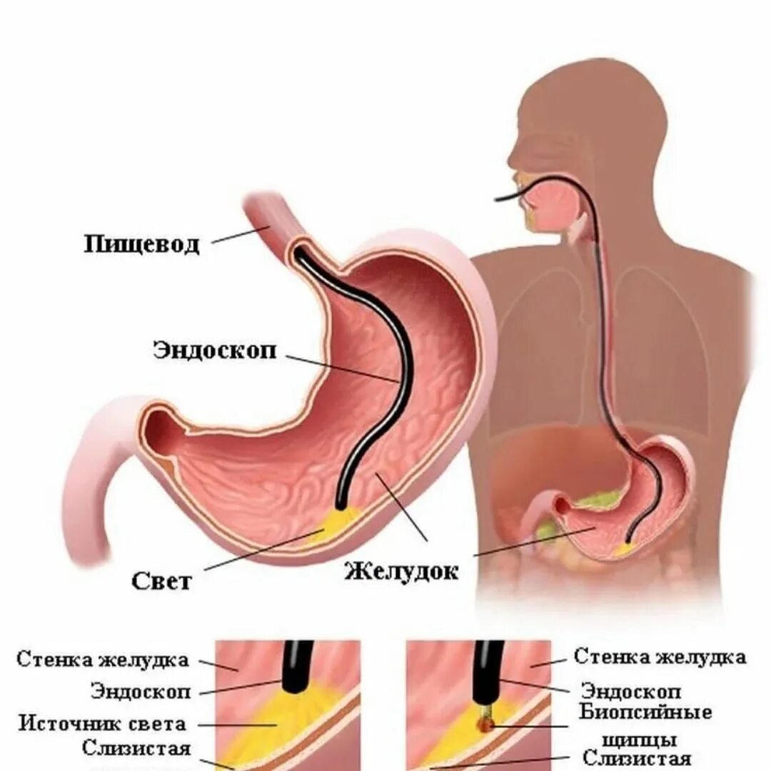 эзофагогастродуоденоскопия язвенная болезнь желудка. гастроскопия двенадцатиперстной кишки. гастроскопия двенадцатиперстной кишки. язва двенадцатиперстной кишки эндоскопия. фгдс метод исследования.
