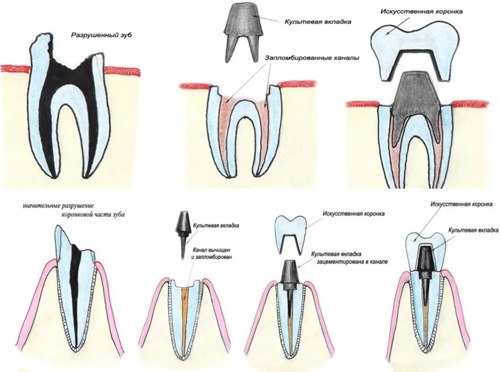 Почему открывают зуб. Культевая вкладка штифт зуб. Штифтово культевая вкладка в зубе. Культевая Штифтовая конструкция. Культевая вкладка и коронка схема.
