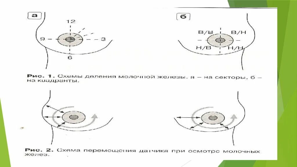 Квадраты молочных желез. Квадранты молочной железы схема. верхнелатеральный квадрант молочной железы. схема ультразвукового исследования молочной железы. квадраты молочной желнзы.