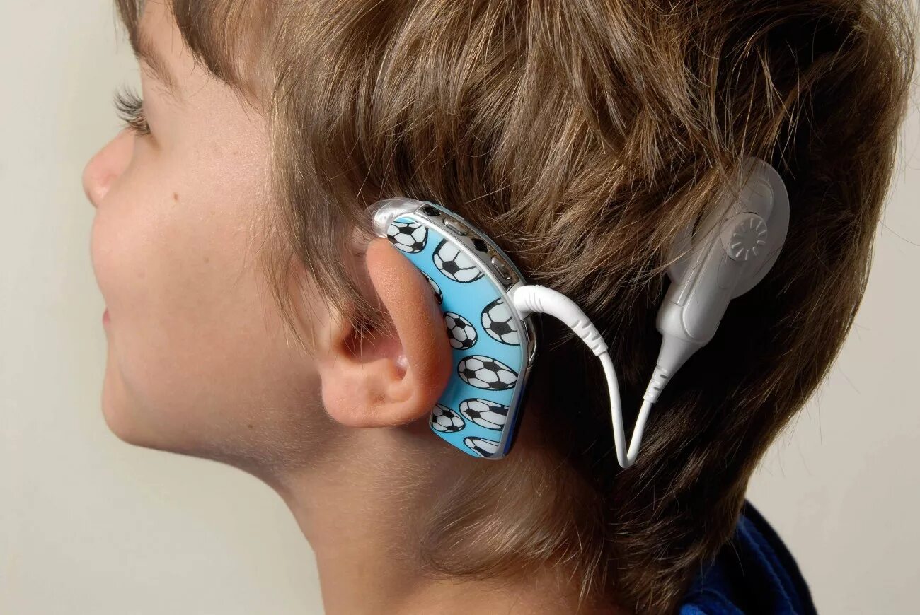 Операция на ухо на слух. Кохлеарная имплантация Cochlear. Аппарат для глухих кохлеарная имплантация. Слуховой аппарат Кохлер имплант.