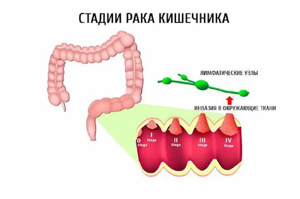 Раковая опухоль кишечника. Стадии онкологии кишечника. Онкология 4а стадия сигмовидной кишки. Онкология прямой кишки стадии