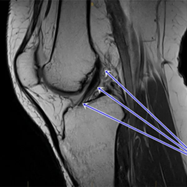 Показать разрыв. Передняя крестообразная связка коленного сустава на мрт. Передняя крестообразная связка мрт норма. Разрыв ПКС коленного сустава на мрт. Сухожилия коленного сустава мрт.