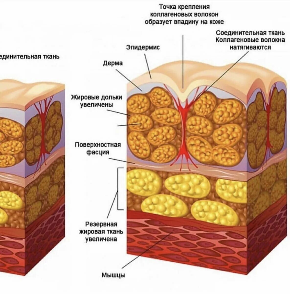 Распад кожи. Подкожно-жировая клетчатка (гиподерма). Гиподерма это подкожная жировая клетчатка. Целлюлит гистология. Подкожно-жировая клетчатка целлюлит.