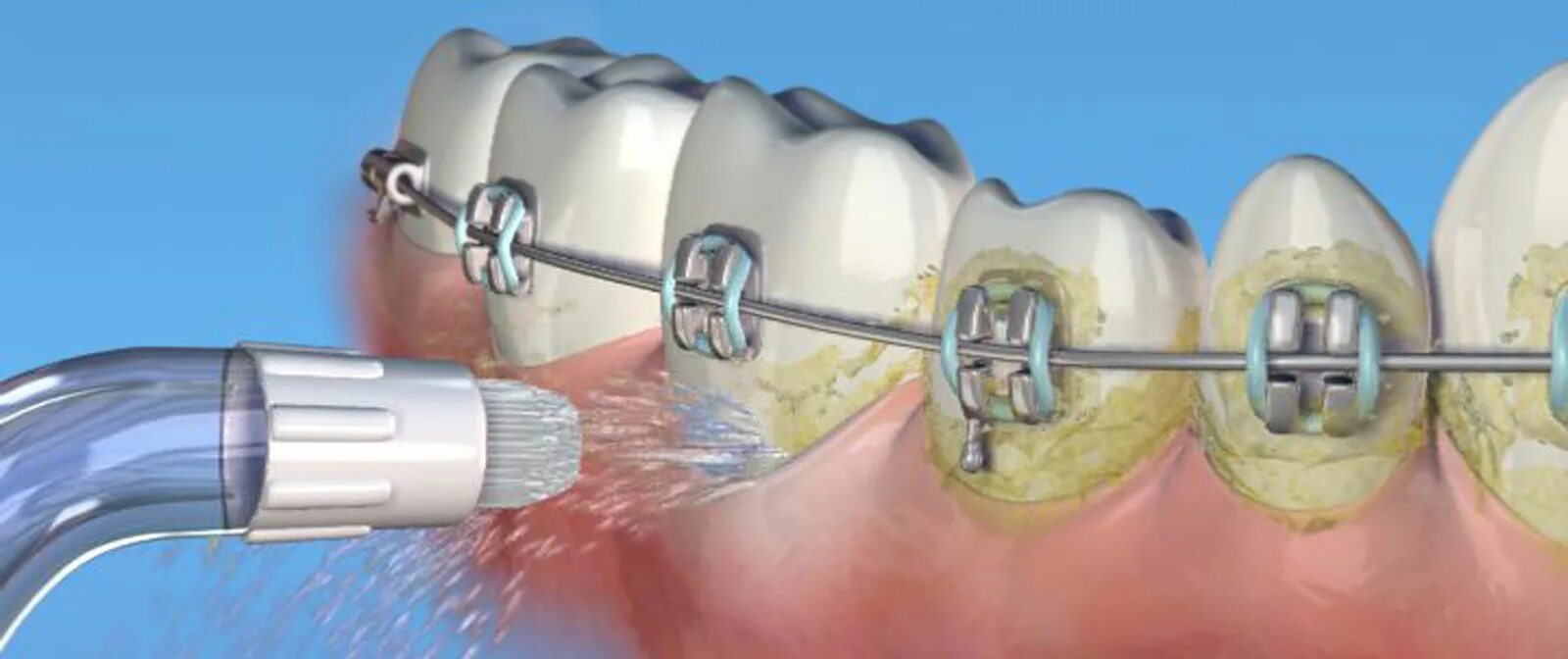 Ортодонтический суперфлосс. Ирригатор для полости рта брекеты. Приборы для чистки зубов с брекетами. Десен системы