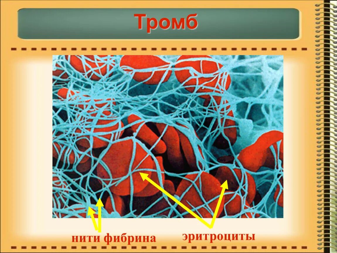 Тромб нити. Наложение нитей фибрина. Нити фибрина под микроскопом.