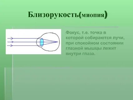Близорукость лучи