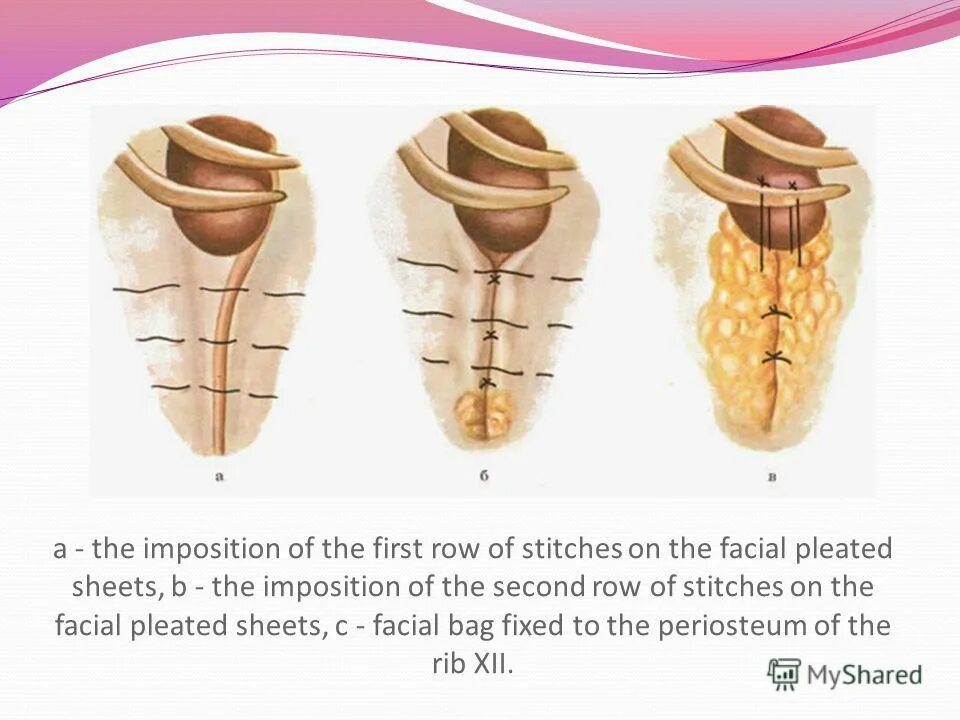 Операция нефропексии. Нефропексия при нефроптозе. Нефроптоз лапароскопическая операция. Ретроперитонеоскопическая нефропексия. Операция пытеля лопаткина.