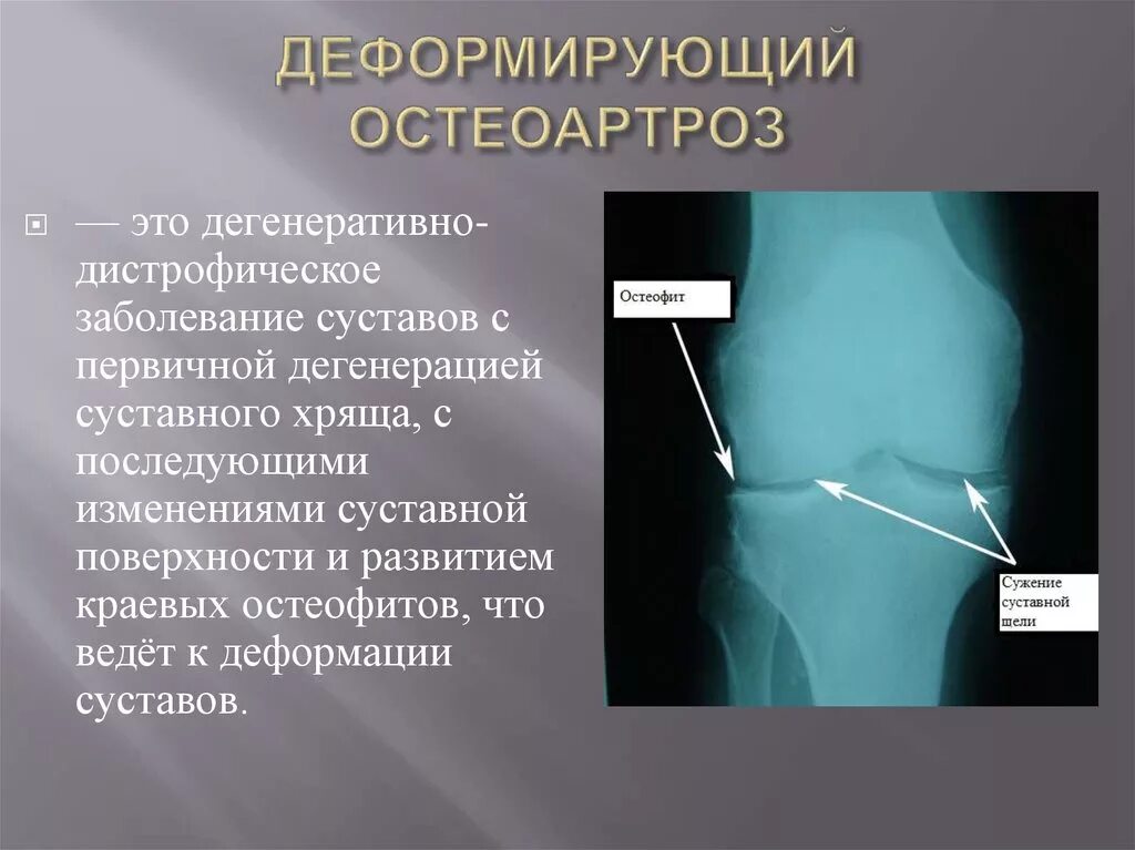 Диагноз доа суставов. Дегенерация суставного хряща. Деформирующий остеоартроз. Дегенеративный остеоартроз.