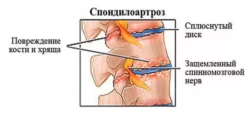 Спондилоартроз это простыми словами у женщин